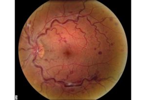 mid atlantic retina at wills eye hospital
