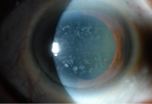 Corneal Dystrophies and Scars | Wills Eye Hospital