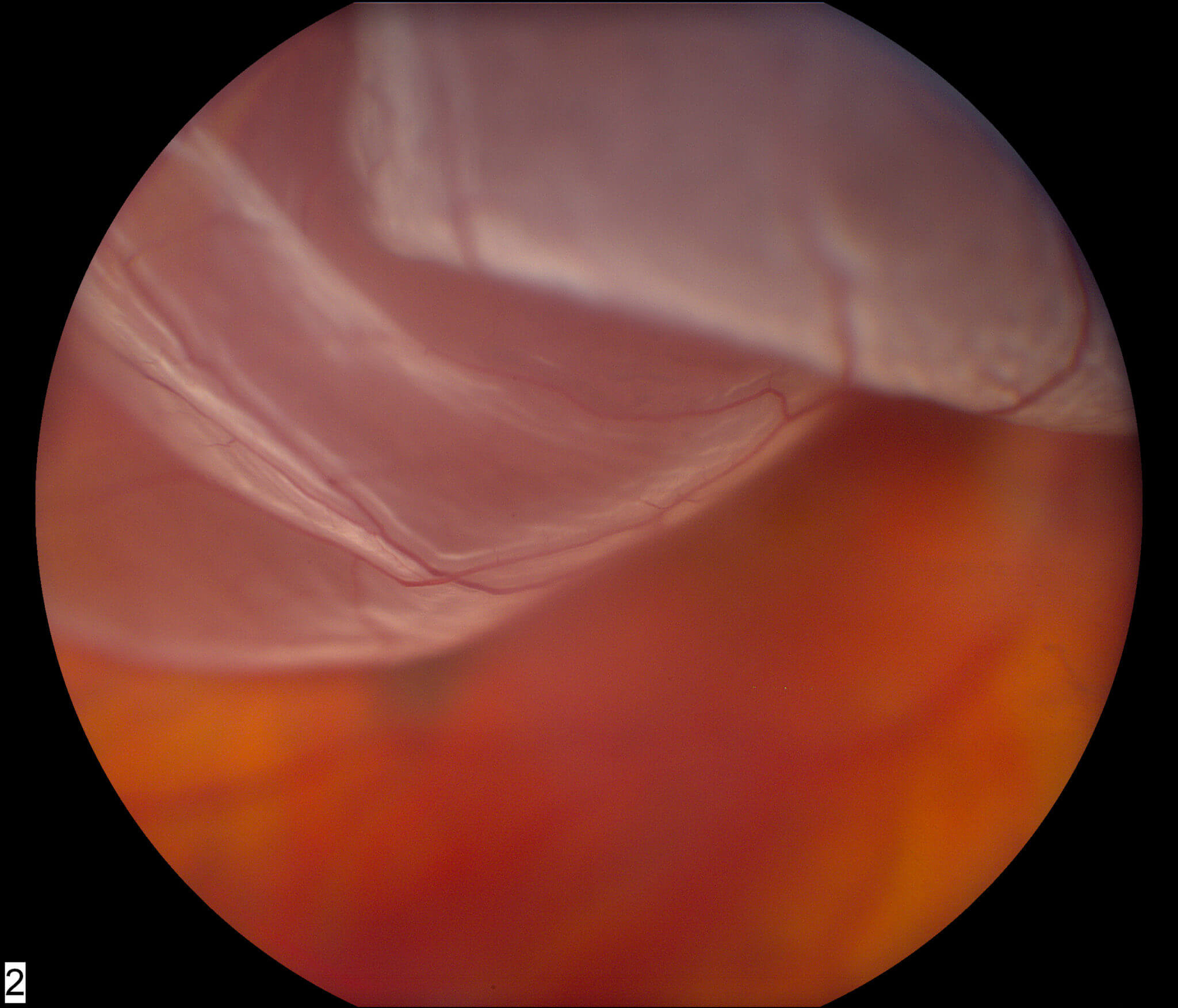 retina tear surgery