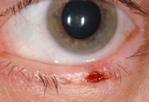 Eyelid Basal Cell Carcinoma | Wills Eye Hospital