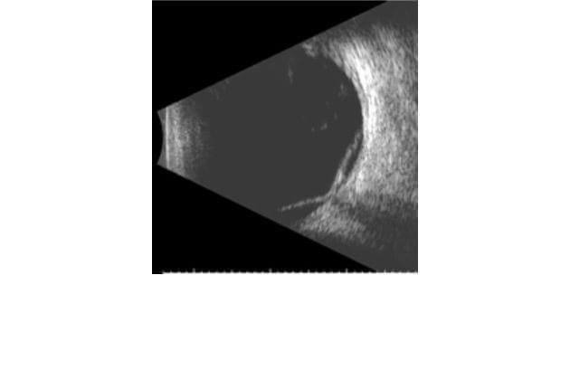 Ultrasonography | Wills Eye Hospital