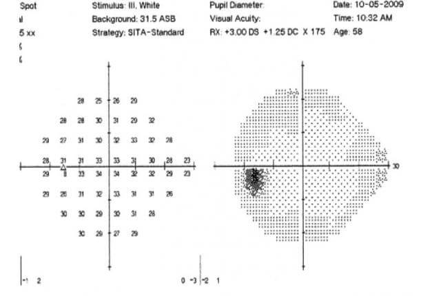 visual-field-normal-wills-eye-hospital