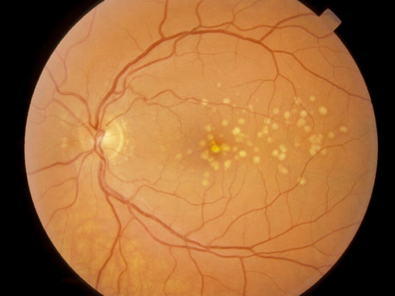wills eye retina specialist