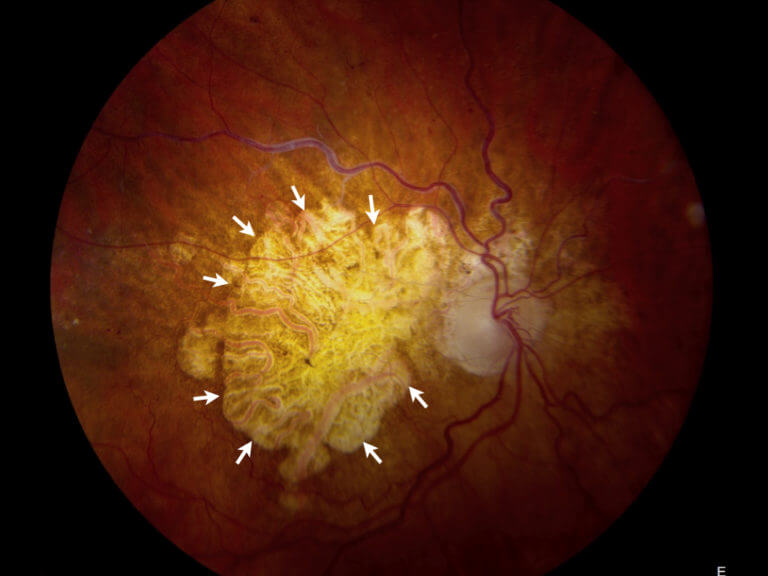 Advanced Macular Degeneration | Wills Eye Hospital