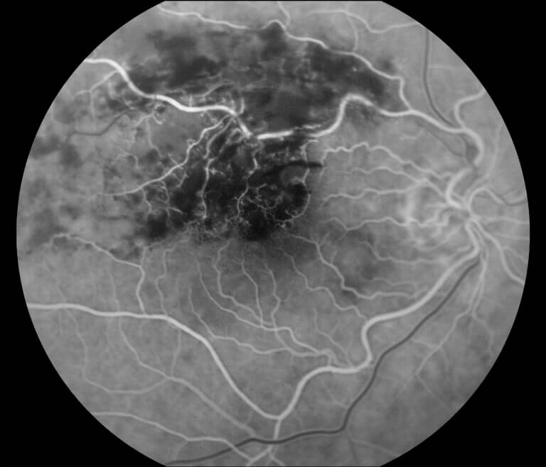 BRVO, Branch Retinal Vein Occlusion, BRVO Eye, BRVO Treatment