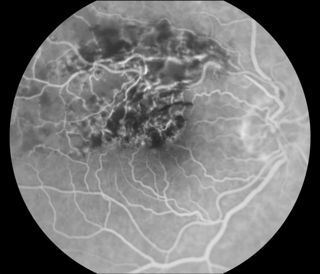 BRVO, Branch Retinal Vein Occlusion, BRVO Eye, BRVO Treatment