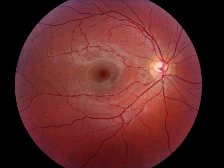 wills eye mid atlantic retina