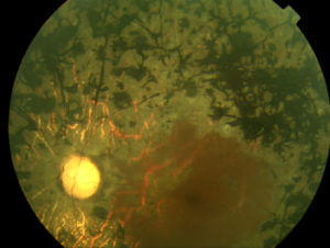 Retinitis Pigmentosa clinical photo 2