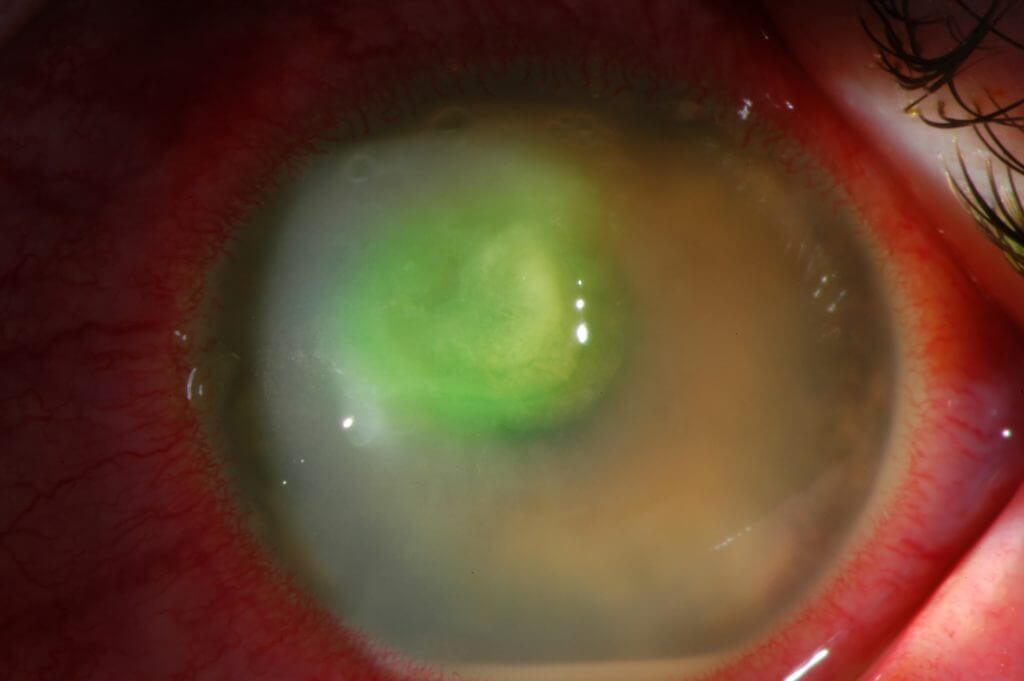 Corneal Ulcers Wills Eye Hospital