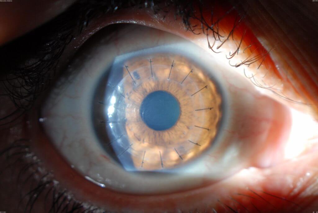 Corneal Transplantation | Wills Eye Hospital