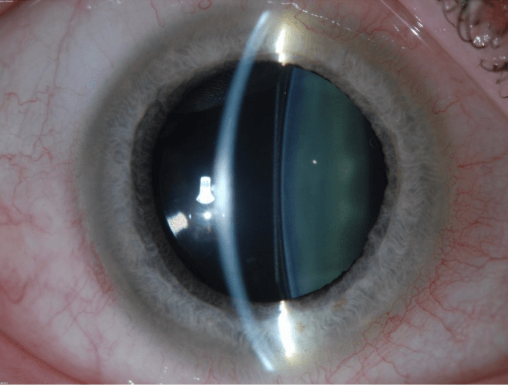Implantable Collamer Lens Icl Surgery Wills Eye Hospital