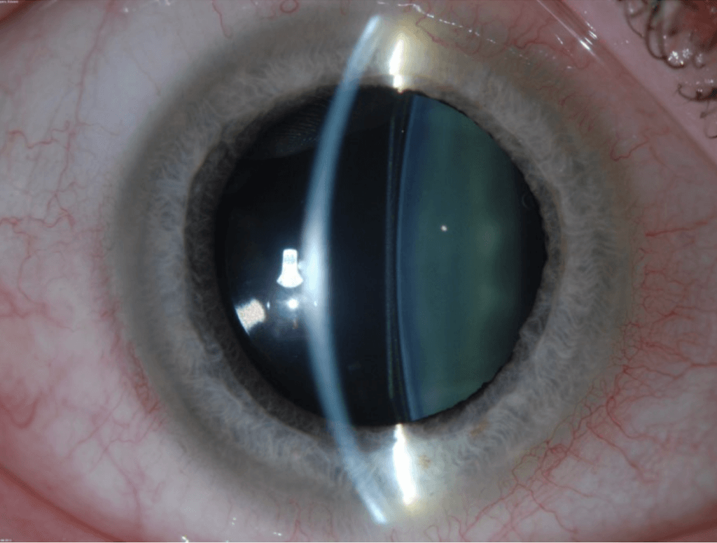 Implantable Collamer Lens (ICL) Surgery | Wills Eye Hospital