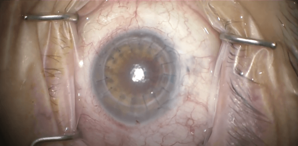 Corneal Transplantation Wills Eye Hospital