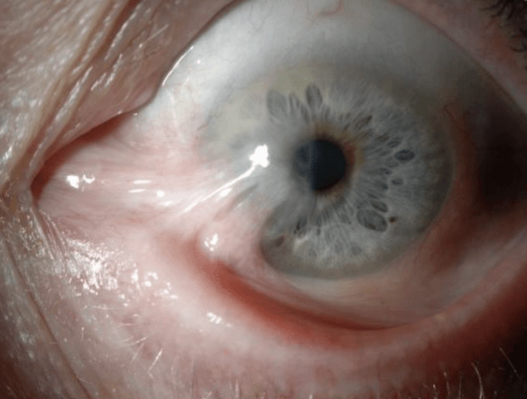 Pterygium Surgery With Conjunctival Transplantation | Wills Eye Hospital